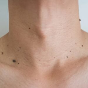 Energia plasmatica acrocordones Doctora Claudia Zabala